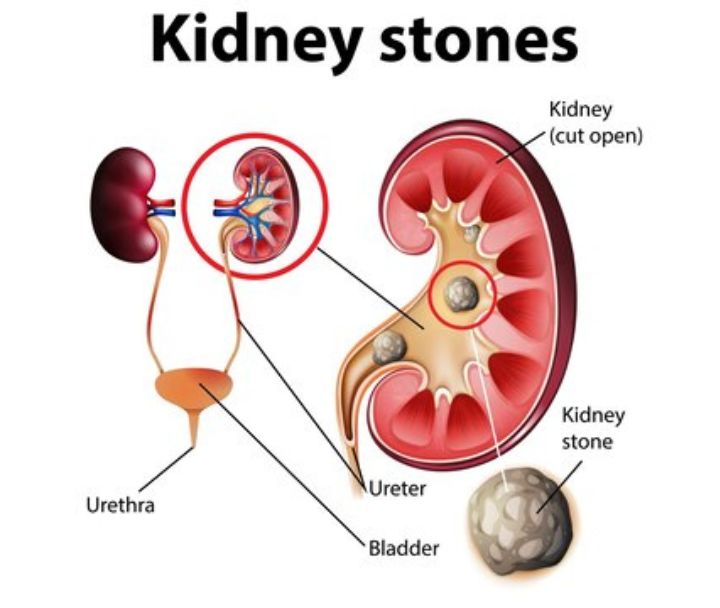 Examples of Alpha Blockers For Kidney Stones
